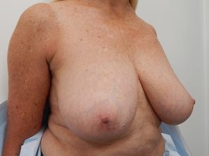 Breast Lift