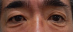 Blepharoplasty