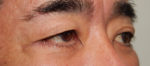 Blepharoplasty