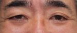 Blepharoplasty