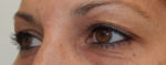 Blepharoplasty