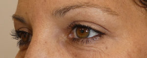 Blepharoplasty