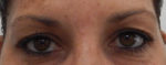 Blepharoplasty