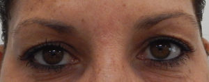 Blepharoplasty