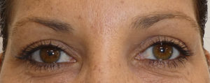 Blepharoplasty
