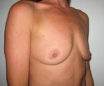 Breast Augmentation