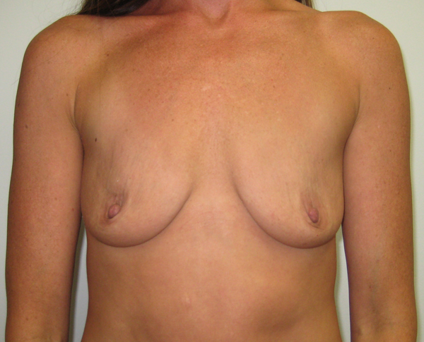 Breast Augmentation Results Long Beach