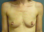 Breast Augmentation