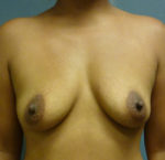 Breast Augmentation