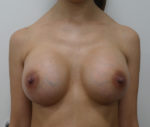 Breast Augmentation