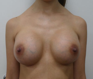 Breast Augmentation