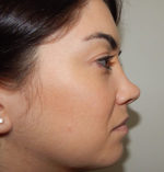 Rhinoplasty