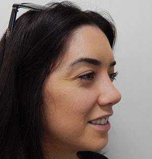 Rhinoplasty