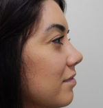 Rhinoplasty