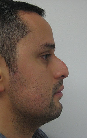 Rhinoplasty