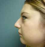 Rhinoplasty