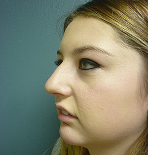 Rhinoplasty