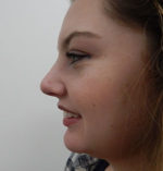 Rhinoplasty