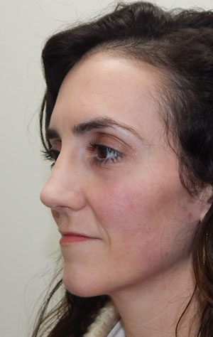 Rhinoplasty