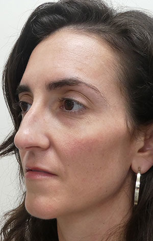 Rhinoplasty
