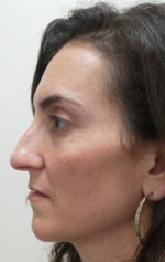 Rhinoplasty