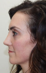 Rhinoplasty