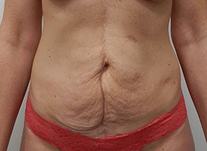 Abdominoplasty