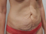 Abdominoplasty