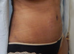 Abdominoplasty