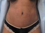 Abdominoplasty