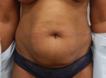 Abdominoplasty