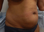 Abdominoplasty