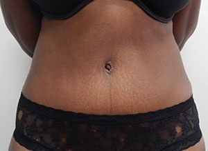 Abdominoplasty