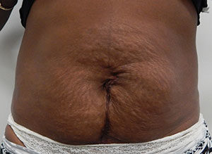 Abdominoplasty