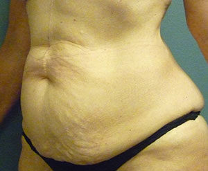 Abdominoplasty