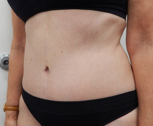 Abdominoplasty