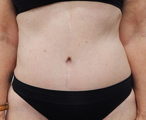 Abdominoplasty