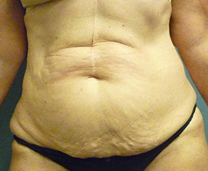 Abdominoplasty