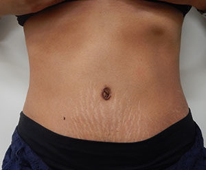 Abdominoplasty