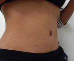 Abdominoplasty