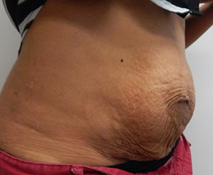 Abdominoplasty