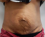 Abdominoplasty