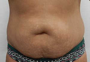 Abdominoplasty