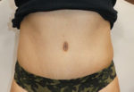 Abdominoplasty