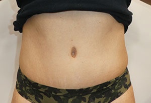 Abdominoplasty