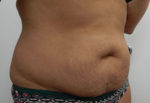 Abdominoplasty