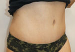 Abdominoplasty