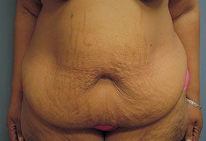 Abdominoplasty