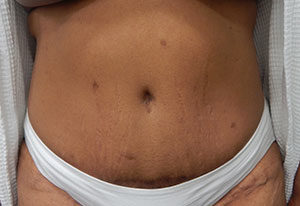 Abdominoplasty