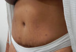 Abdominoplasty